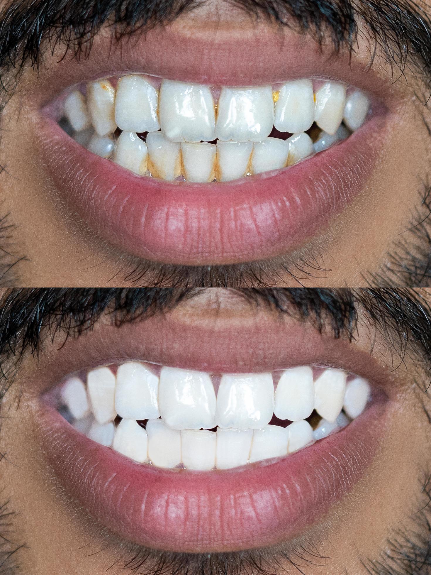 Resultado odontológico antes e depois 2