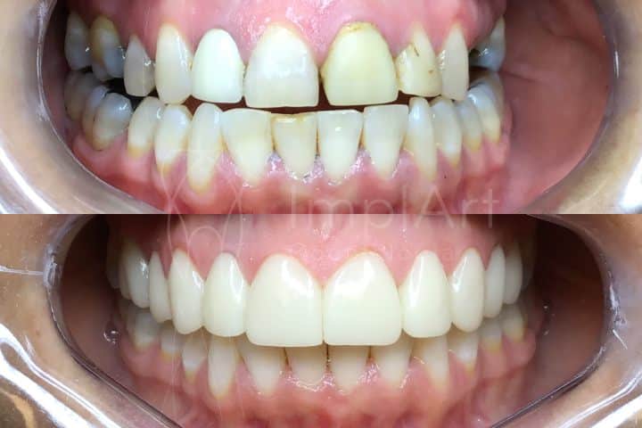 Resultado odontológico antes e depois 3