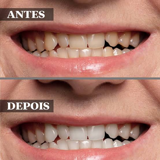 Resultado odontológico antes e depois 1