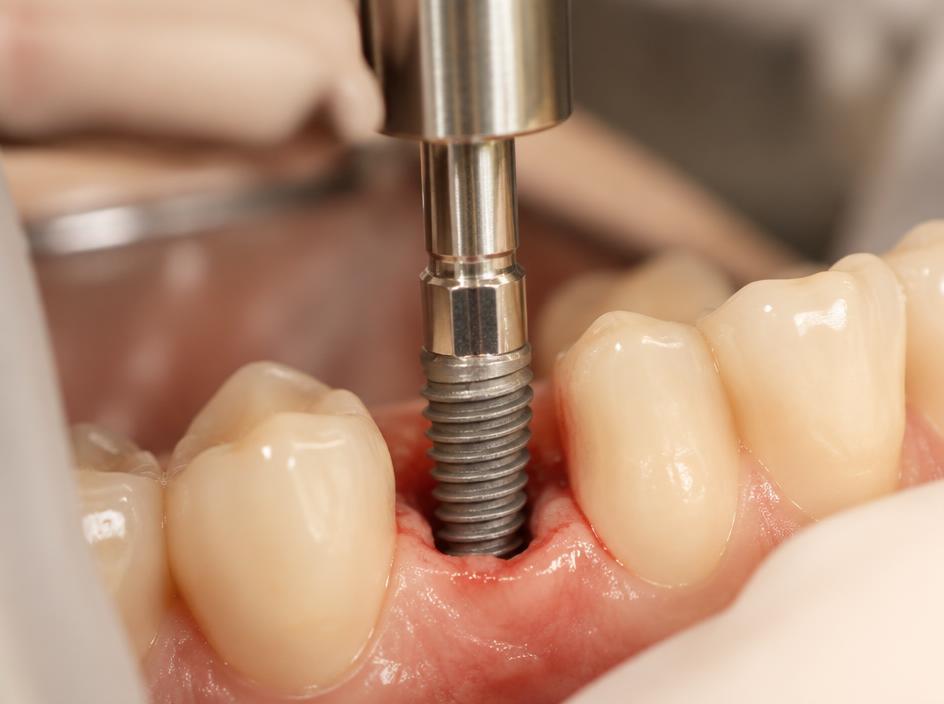 Implantes Dentários